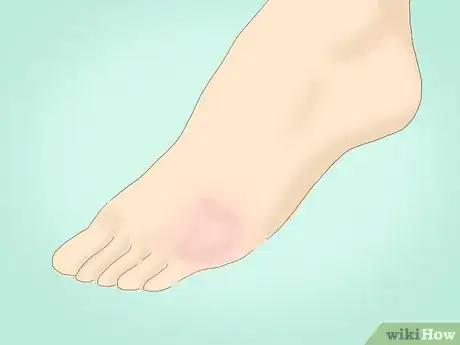 Image intitulée Treat a Sore Toe Step 1