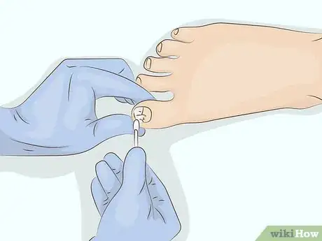 Image intitulée Cure Onycholysis Step 1