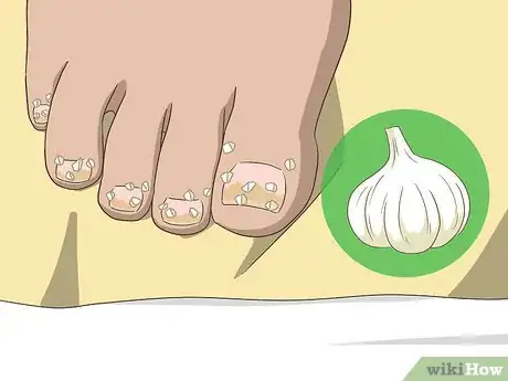 Image intitulée Treat Toe Nail Fungus Step 5