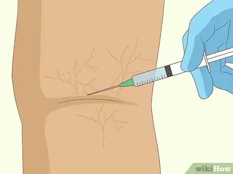 Image intitulée Remove Spider Veins Step 1