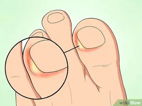 Image intitulée Tell if an Ingrown Toenail Is Infected Step 3
