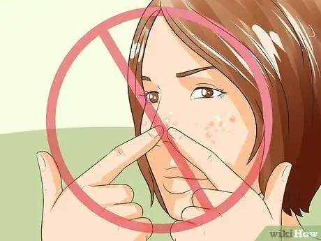 Image intitulée Get Rid of Pimples Naturally (Sea Salt Method) Step 35