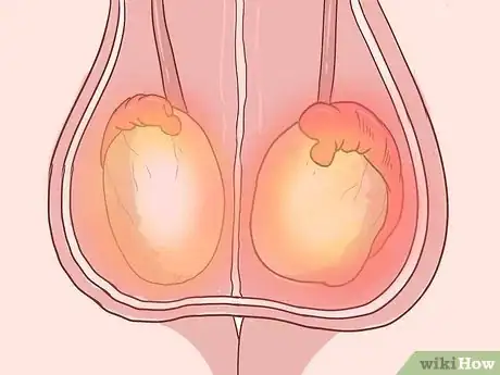 Image intitulée Treat Pain and Swelling in the Testicles Step 10