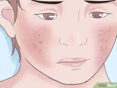 Image intitulée Know if Your Child Has Scarlet Fever Step 8