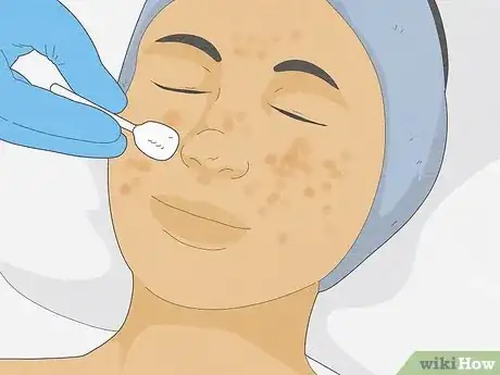 Image intitulée Get Rid of Cystic Acne Scars Step 11