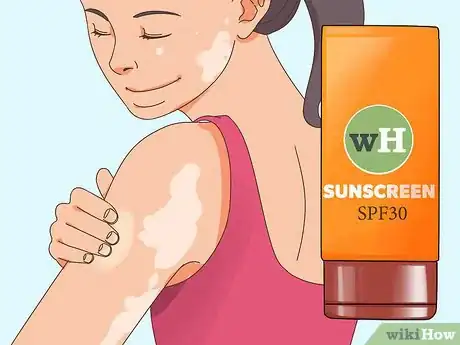 Image intitulée Prevent Vitiligo Step 1