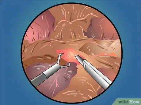 Image intitulée Treat a Bleeding Ulcer Step 13