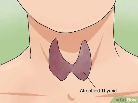 Image intitulée Heal Your Thyroid Naturally Step 16