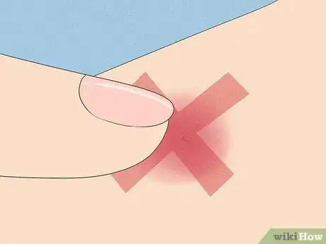 Image intitulée Stop Scratching Irritated Skin Step 2