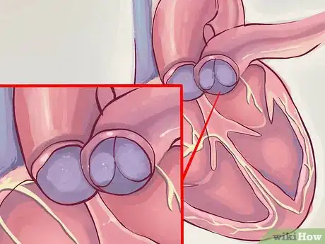 Image intitulée Interpret Echocardiograms Step 4