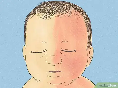 Image intitulée Know What to Expect on a Newborn's Skin Step 13