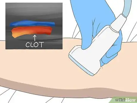 Image intitulée Dissolve Blood Clots Step 20