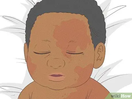 Image intitulée Know What to Expect on a Newborn's Skin Step 18