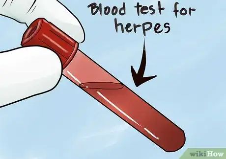 Image intitulée Test for Herpes Step 4