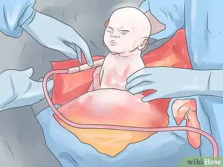 Image intitulée Prepare for a Cesarean Section Step 13