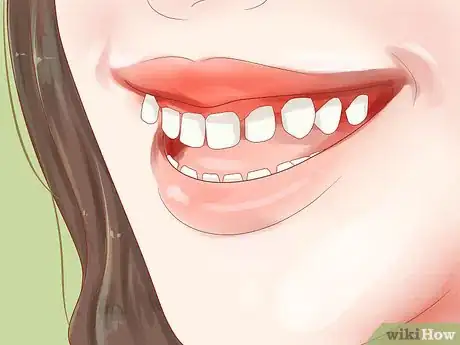 Image intitulée Determine if You Need Braces Step 3