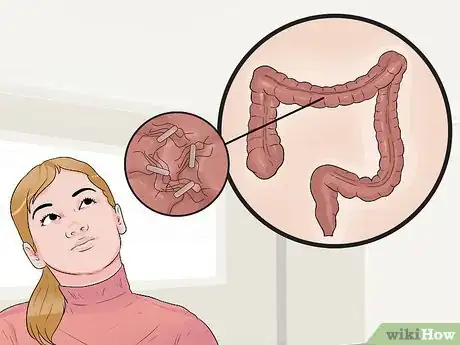 Image intitulée Distinguish Ulcerative Colitis from Similar Conditions Step 10