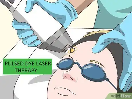 Image intitulée Remove Facial Warts Step 11