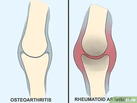 Image intitulée Recognize Arthritis Symptoms Step 11