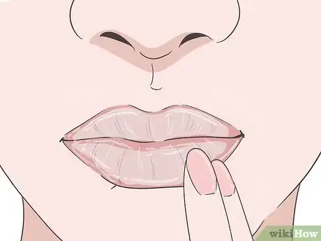 Image intitulée Heal a Lip Burn Step 2