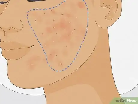 Image intitulée Get Rid of Cystic Acne Scars Step 14