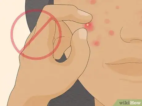 Image intitulée Get Rid of Cystic Acne Scars Step 21