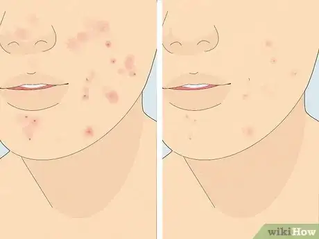 Image intitulée Reduce Acne Using Tomatoes Step 2