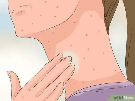 Image intitulée Recognize Chickenpox Step 13