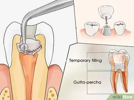 Image intitulée Treat a Tooth Abscess Step 6