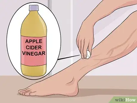 Image intitulée Get Rid of Varicose Veins Step 19