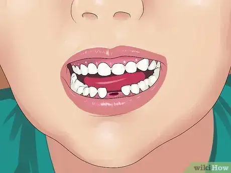 Image intitulée Stop the Bleeding After You Pull out a Loose Tooth Step 2