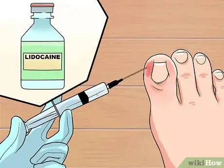 Image intitulée Cure an Infected Toe Step 5