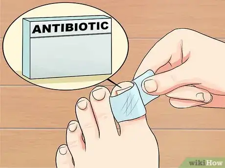 Image intitulée Cure an Infected Toe Step 3