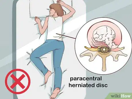 Image intitulée Sleep with a Ruptured Disc Step 2