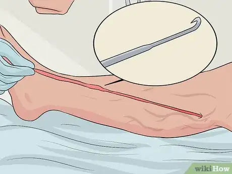 Image intitulée Get Rid of Varicose Veins Step 15