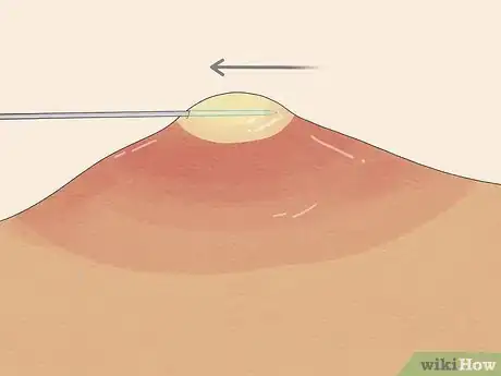 Image intitulée Pop a Pimple Step 14