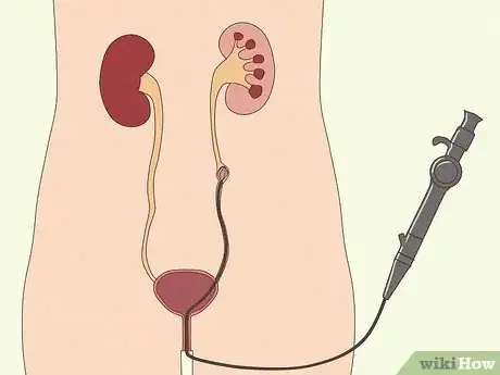 Image intitulée Get Rid of Kidney Stones Step 5