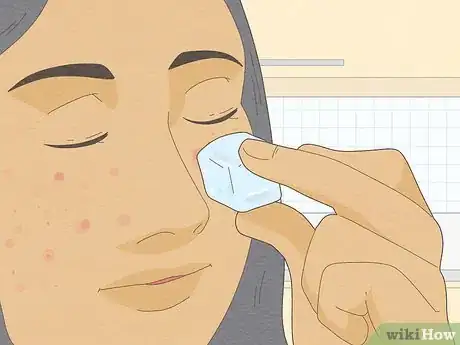 Image intitulée Get Rid of a Popped Pimple Overnight Step 1