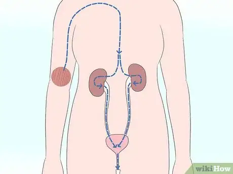 Image intitulée Bring Down High Creatinine Levels Step 1