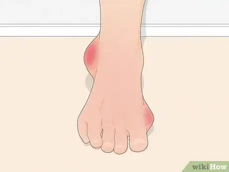 Image intitulée Treat Gout Step 1