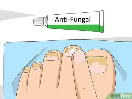 Image intitulée Treat Toe Nail Fungus Step 3
