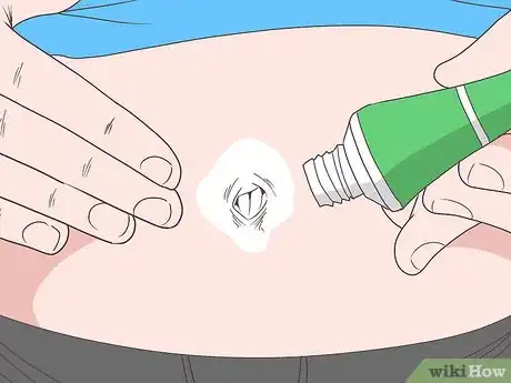 Image intitulée Treat an Infection in Your Belly Button Step 6