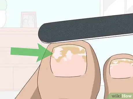 Image intitulée Treat Toe Nail Fungus Step 2