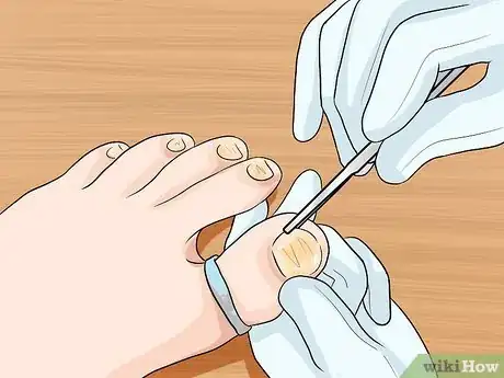 Image intitulée Get Rid of Yellow Toenails Step 5