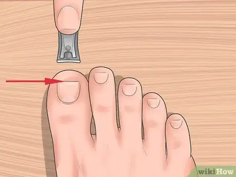 Image intitulée Tell if You Have an Ingrown Toenail Step 10