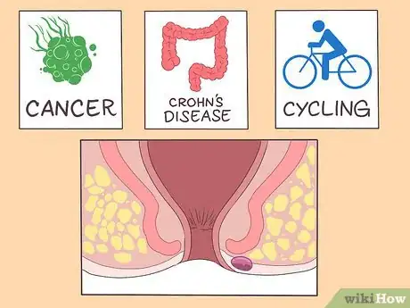 Image intitulée Prevent Perianal Abscess from Returning Step 13