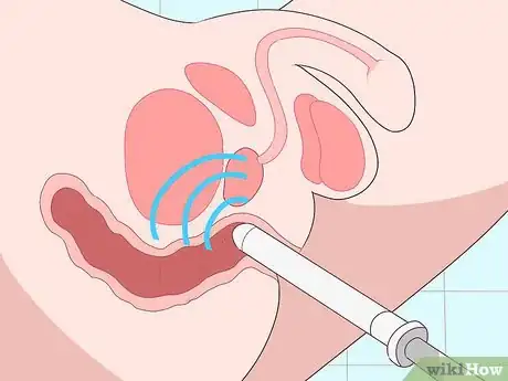 Image intitulée Prevent Perianal Abscess from Returning Step 15