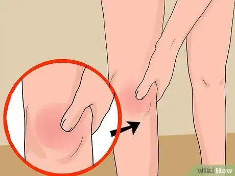 Image intitulée Treat a Swollen Knee Step 1