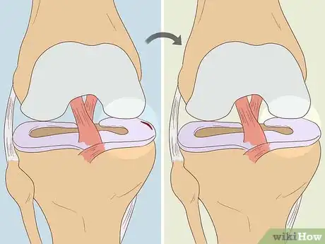 Image intitulée Heal a Meniscus Tear Step 5