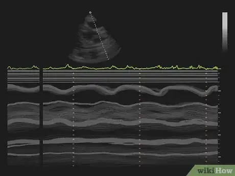 Image intitulée Interpret Echocardiograms Step 8